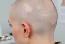 Deuruxolitinib for Alopecia Areata Image of woman's shaven head, affected by Alopecia Areata