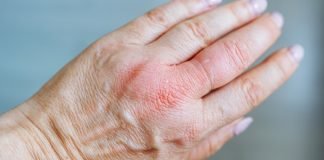Delgocitinib Cream for Chronic Hand Dermatitis: Efficacy, Safety and Clinical Application image of human hand with traces of hand dermatitis